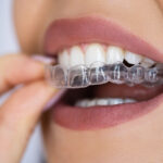 Clear Aligner Braces: The Modern, Discreet Path to a Straighter Smile